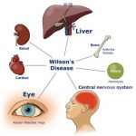 wilson disease